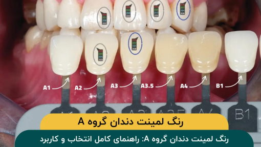 رنگ-لمینت-دندان-a1